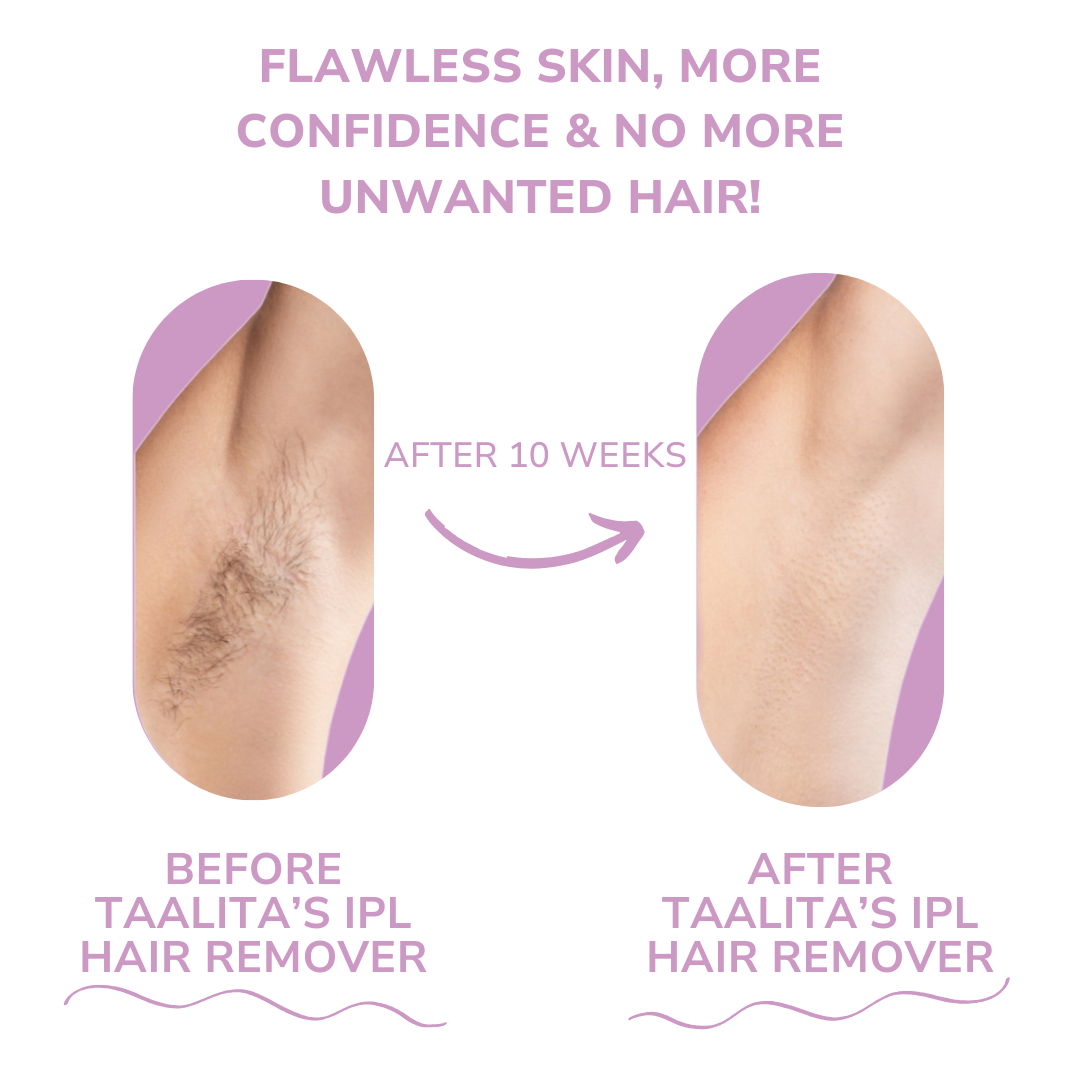 IPL Hair Remover™ -  Pain-Free Path to Smooth Skin