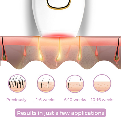 IPL Hair Remover™ -  Pain-Free Path to Smooth Skin